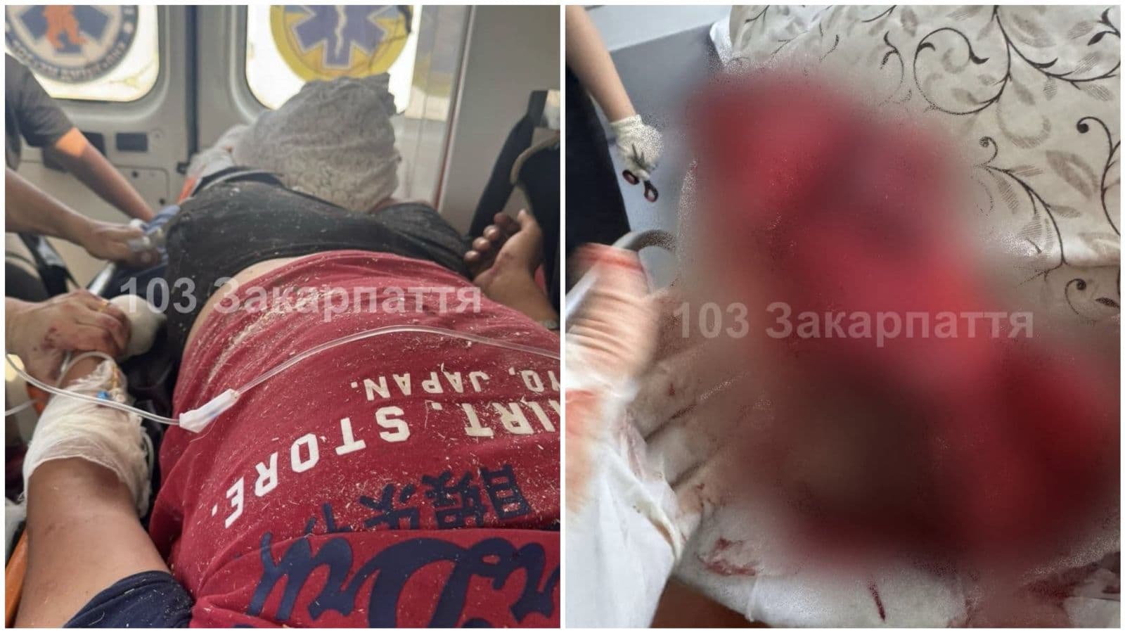 Зображення для статті: Тяжка травма на Тячівщині: 17-річний хлопець постраждав під час роботи з циркулярною пилою