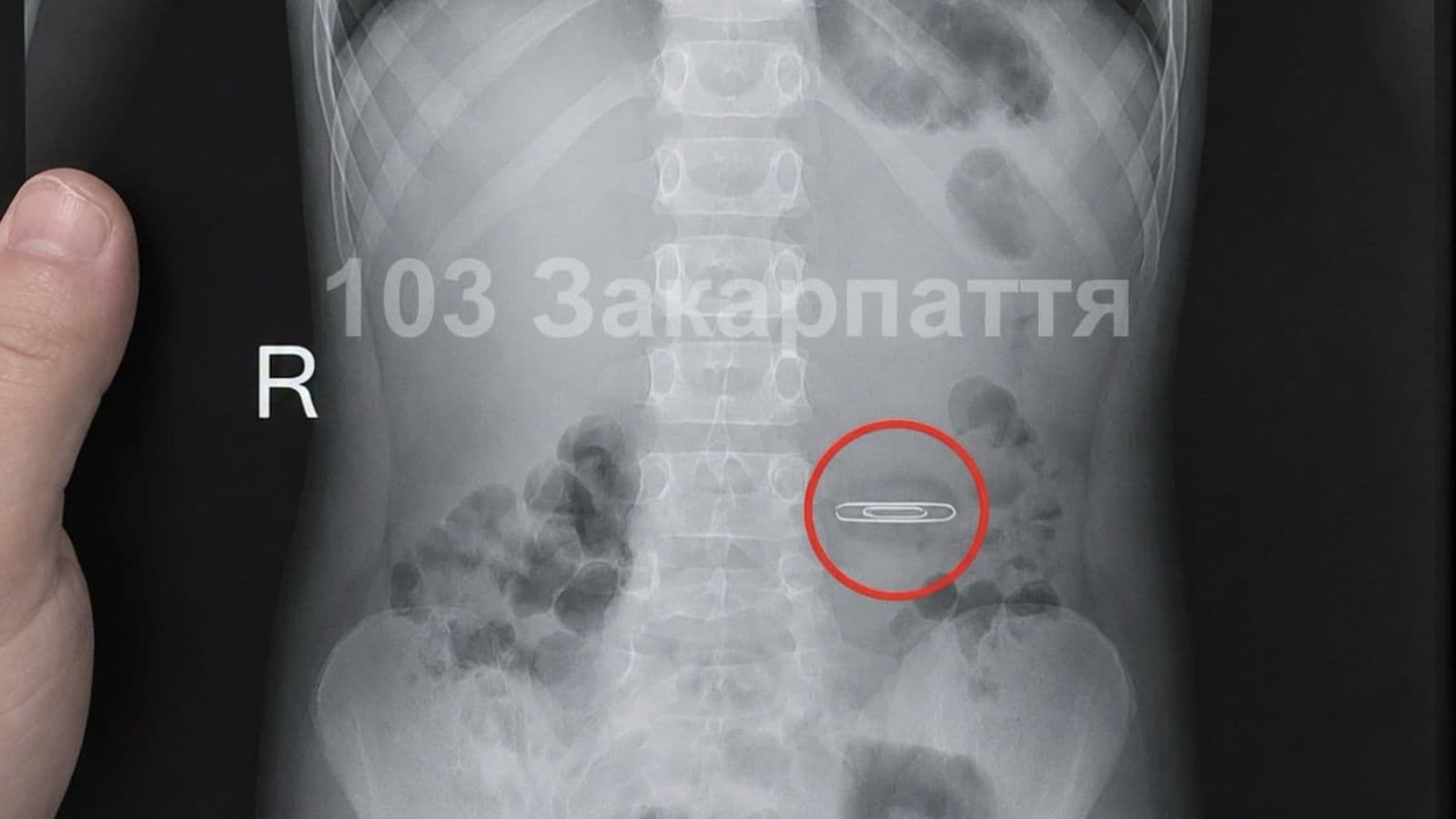 Зображення для статті: 5-річний хлопчик на Закарпатті проковтнув металеву скріпку: дитину доправили до обласної лікарні