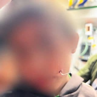 Зображення для статті: У Міжгір’ї 5-річний хлопчик встромив рибацький гачок у щоку під час гри
