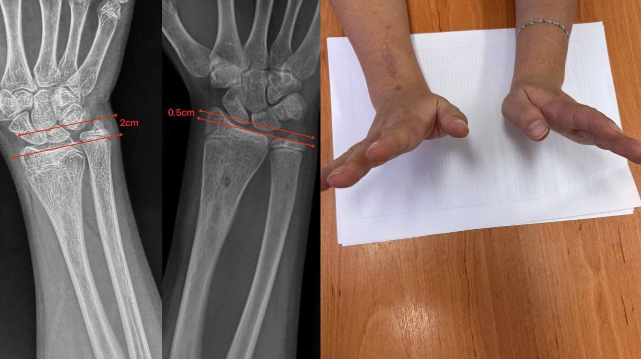 Зображення для статті: Лікарі Закарпаття відновили нормальний ріст кістки у дитини