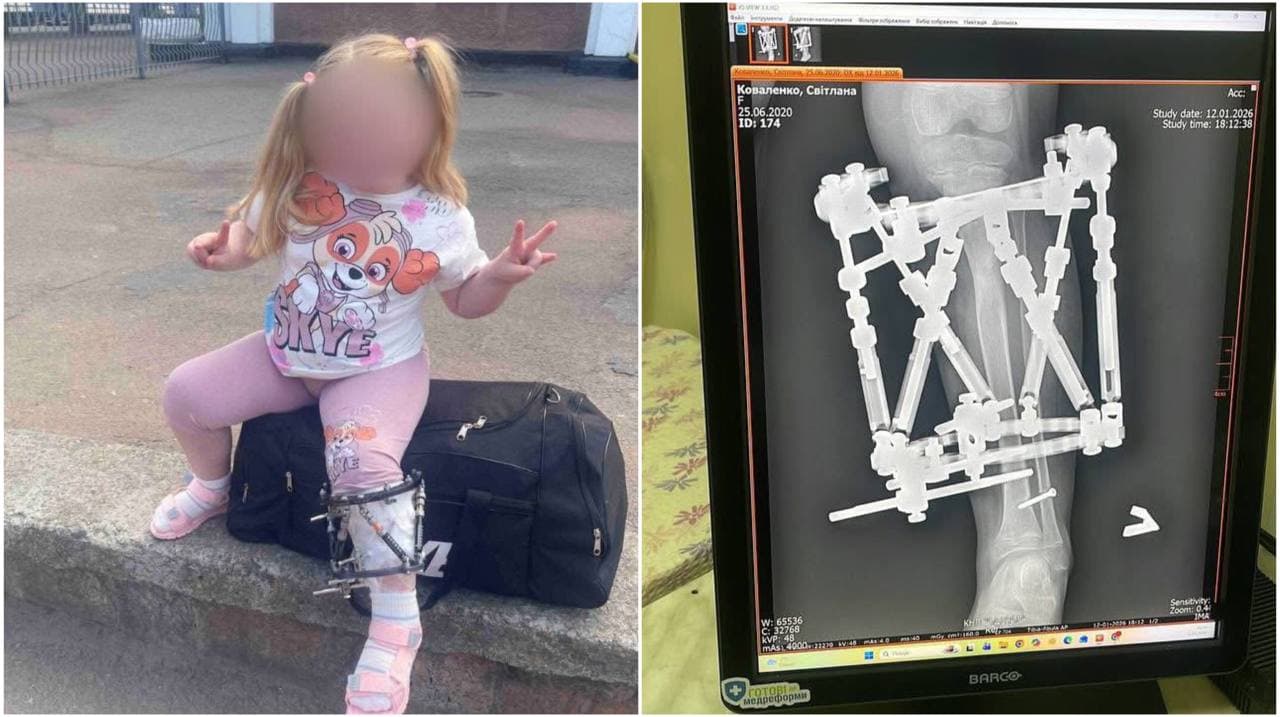 Зображення для статті: У Закарпатській обласній дитячій лікарні успішно прооперували дитину з вкороченою кінцівкою